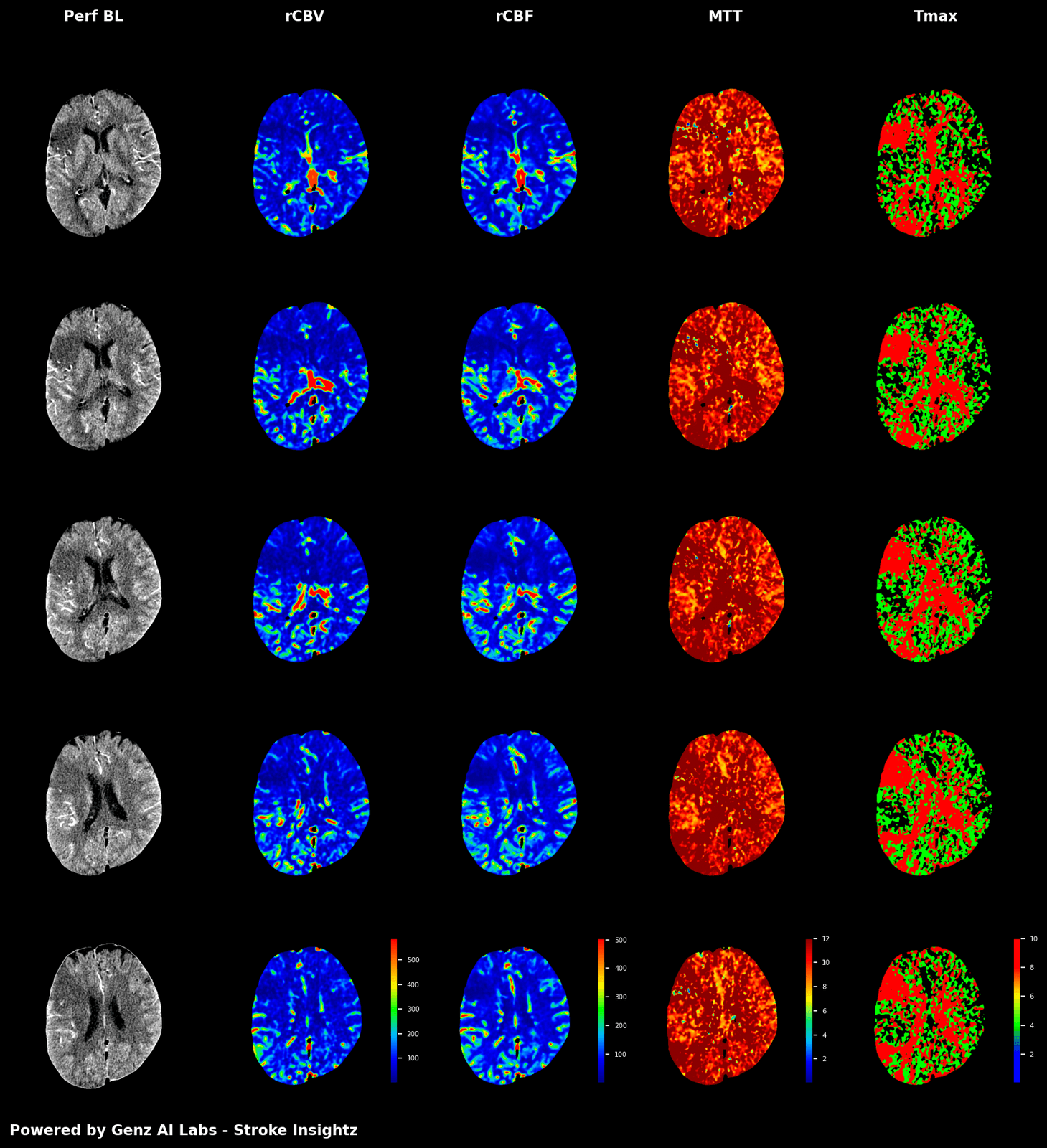 Full perfusion parameter maps — Perf BL, rCBV, rCBF, MTT, Tmax
